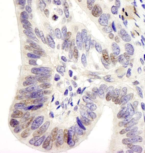 USP28 Antibody - Detection of Human USP28 by Immunohistochemistry. Sample: FFPE section of human stomach adenocarcinoma. Antibody: Affinity purified rabbit anti-USP28 used at a dilution of 1:250.