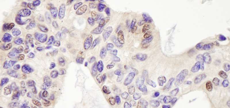 USP28 Antibody - Detection of Human USP28 by Immunohistochemistry. Sample: FFPE section of human ovarian carcinoma. Antibody: Affinity purified rabbit anti-USP28 used at a dilution of 1:1000 (0.2 ug/ml). Detection: DAB.
