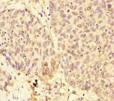 USP28 Antibody - Immunohistochemistry of paraffin-embedded human ovarian cancer at dilution of 1:100