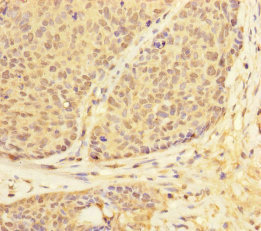 USP28 Antibody - Immunohistochemistry of paraffin-embedded human ovarian cancer at dilution of 1:100