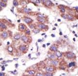 USP3 / UBP Antibody - Formalin-fixed and paraffin-embedded human cancer tissue reacted with the primary antibody, which was peroxidase-conjugated to the secondary antibody, followed by DAB staining. This data demonstrates the use of this antibody for immunohistochemistry; clinical relevance has not been evaluated. BC = breast carcinoma; HC = hepatocarcinoma.