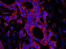USP3 / UBP Antibody - Detection of Human USP3 by IHC-IF. Sample: FFPE section of human ovarian carcinoma. Antibody: Affinity purified rabbit anti-USP3 used at a dilution of 1:100. Detection: Red-fluorescent goat anti-rabbit IgG highly cross-adsorbed Antibody Hilyte Plus 555 (A120-501E) used at a dilution of 1:100.