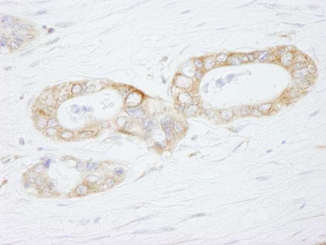 USP3 / UBP Antibody - Detection of Human USP3 by Immunohistochemistry. Sample: FFPE section of human ovarian carcinoma. Antibody: Affinity purified rabbit anti-USP3 used at a dilution of 1:500.