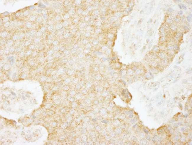USP3 / UBP Antibody - Detection of Human USP3 by Immunohistochemistry. Sample: FFPE section of human pancreatic islet cell tumor. Antibody: Affinity purified rabbit anti-USP3 used at a dilution of 1:100.
