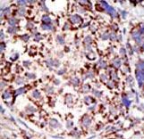 USP3 / UBP Antibody - Formalin-fixed and paraffin-embedded human cancer tissue reacted with the primary antibody, which was peroxidase-conjugated to the secondary antibody, followed by DAB staining. This data demonstrates the use of this antibody for immunohistochemistry; clinical relevance has not been evaluated. BC = breast carcinoma; HC = hepatocarcinoma.