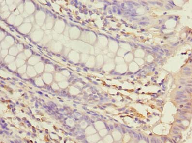 USP30 Antibody - Immunohistochemistry of paraffin-embedded human colon cancer using antibody at dilution of 1:100.