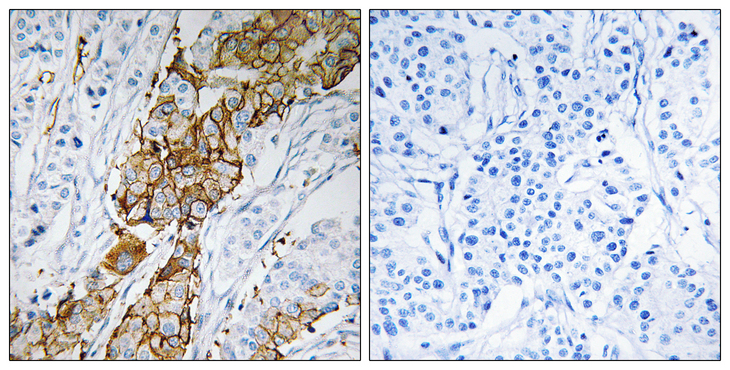 USP32 Antibody - Immunohistochemistry analysis of paraffin-embedded human breast carcinoma tissue, using USP32 Antibody. The picture on the right is blocked with the synthesized peptide.