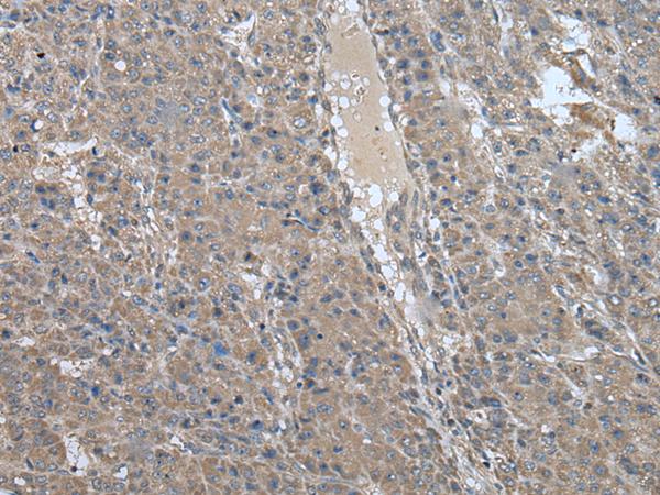 USP32 Antibody - Immunohistochemistry of paraffin-embedded Human liver cancer tissue  using USP32 Polyclonal Antibody at dilution of 1:75(×200)