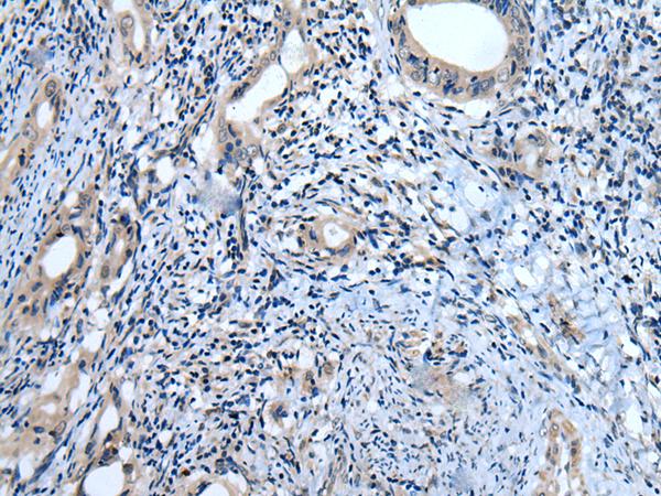 USP32 Antibody - Immunohistochemistry of paraffin-embedded Human cervical cancer tissue  using USP32 Polyclonal Antibody at dilution of 1:75(×200)