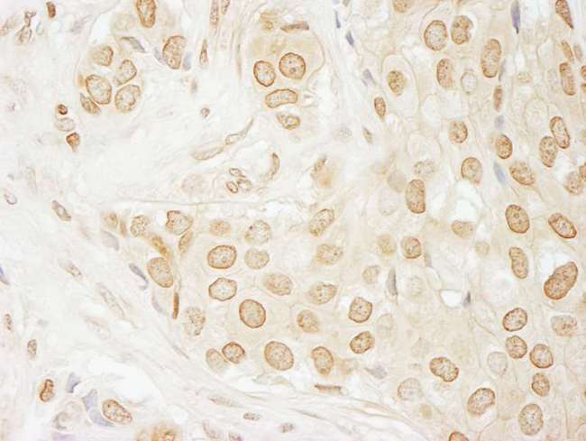 USP33 / VDU1 Antibody - Detection of Human USP33 by Immunohistochemistry. Sample: FFPE section of human breast carcinoma. Antibody: Affinity purified rabbit anti-USP33 used at a dilution of 1:1000 (1 ug/ml). Detection: DAB.