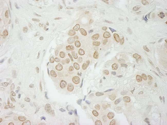 USP33 / VDU1 Antibody - Detection of Human USP33 by Immunohistochemistry. Sample: FFPE section of human breast carcinoma. Antibody: Affinity purified rabbit anti-USP33 used at a dilution of 1:250. Epitope Retrieval Buffer-High pH (IHC-101J) was substituted for Epitope Retrieval Buffer-Reduced pH.