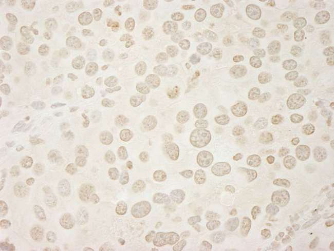 USP33 / VDU1 Antibody - Detection of Mouse USP33 by Immunohistochemistry. Sample: FFPE section of mouse renal cell carcinoma. Antibody: Affinity purified rabbit anti-USP33 used at a dilution of 1:250. Epitope Retrieval Buffer-High pH (IHC-101J) was substituted for Epitope Retrieval Buffer-Reduced pH.