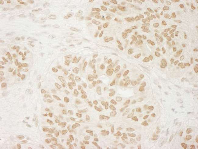 USP33 / VDU1 Antibody - Detection of Human USP33 by Immunohistochemistry. Sample: FFPE section of human ovarian carcinoma. Antibody: Affinity purified rabbit anti-USP33 used at a dilution of 1:1000 (1 ug/ml). Detection: DAB.