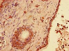 USP33 / VDU1 Antibody - Immunohistochemistry of paraffin-embedded human prostate cancer using USP33 Antibody at dilution of 1:100