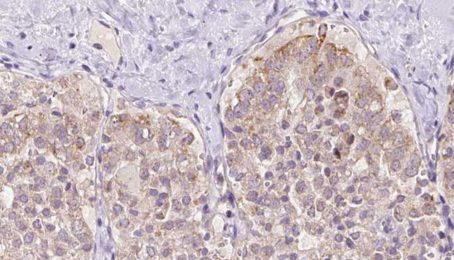 USP33 / VDU1 Antibody - 1:100 staining human thyroid carcinoma tissue by IHC-P. The sample was formaldehyde fixed and a heat mediated antigen retrieval step in citrate buffer was performed. The sample was then blocked and incubated with the antibody for 1.5 hours at 22°C. An HRP conjugated goat anti-rabbit antibody was used as the secondary.