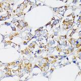 USP33 / VDU1 Antibody - Immunohistochemistry of paraffin-embedded Human breast cancer using USP33 Polyclonal Antibody at dilution of 1:100 (40x lens).