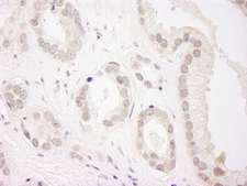 USP34 Antibody - Detection of Human USP34 by Immunohistochemistry. Sample: FFPE section of human prostate carcinoma. Antibody: Affinity purified rabbit anti-USP34 used at a dilution of 1:200 (1 ug/ml). Detection: DAB.
