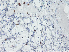 USP36 Antibody - IHC of paraffin-embedded Carcinoma of Human kidney tissue using anti-USP36 mouse monoclonal antibody.