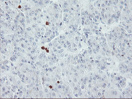 USP36 Antibody - IHC of paraffin-embedded Carcinoma of Human liver tissue using anti-USP36 mouse monoclonal antibody.