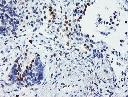 USP36 Antibody - IHC of paraffin-embedded Carcinoma of Human lung tissue using anti-USP36 mouse monoclonal antibody.
