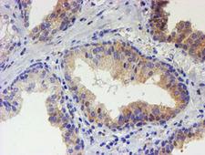 USP36 Antibody - IHC of paraffin-embedded Carcinoma of Human prostate tissue using anti-USP36 mouse monoclonal antibody.