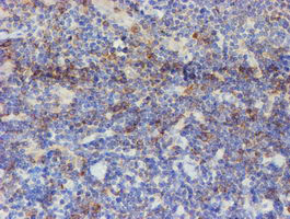 USP36 Antibody - IHC of paraffin-embedded Human lymphoma tissue using anti-USP36 mouse monoclonal antibody.