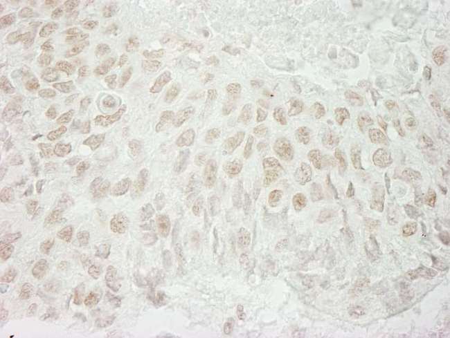 USP37 Antibody - Detection of Human USP37 by Immunohistochemistry. Sample: FFPE section of human non-small cell lung cancer. Antibody: Affinity purified rabbit anti-USP37 used at a dilution of 1:1000 (1 ug/ml). Detection: DAB.
