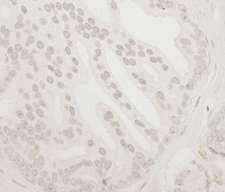 USP37 Antibody - Detection of Human USP37 by Immunohistochemistry. Sample: FFPE section of human prostate carcinoma. Antibody: Affinity purified rabbit anti-USP37 used at a dilution of 1:250. Epitope Retrieval Buffer-High pH (IHC-101J) was substituted for Epitope Retrieval Buffer-Reduced pH.