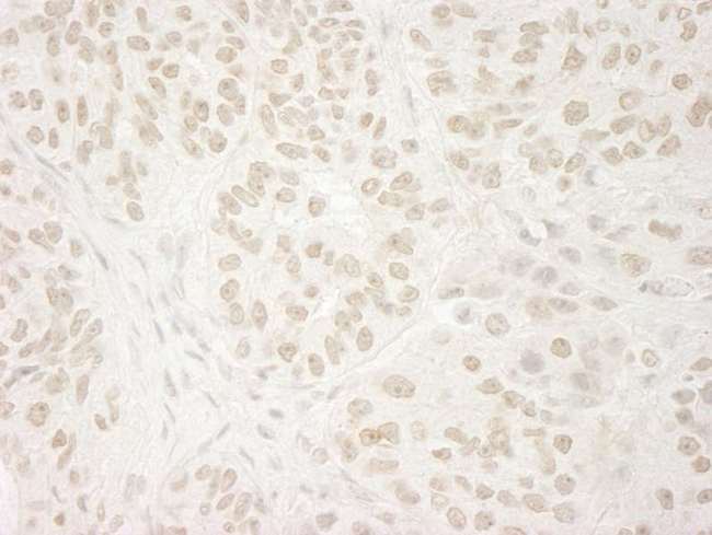 USP37 Antibody - Detection of Human USP37 by Immunohistochemistry. Sample: FFPE section of human ovarian carcinoma. Antibody: Affinity purified rabbit anti-USP37 used at a dilution of 1:250. Epitope Retrieval Buffer-High pH (IHC-101J) was substituted for Epitope Retrieval Buffer-Reduced pH.