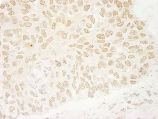 USP37 Antibody - Detection of Human USP37 by Immunohistochemistry. Sample: FFPE section of human non-small cell lung cancer. Antibody: Affinity purified rabbit anti-USP37 used at a dilution of 1:200 (1 ug/ml). Detection: DAB.