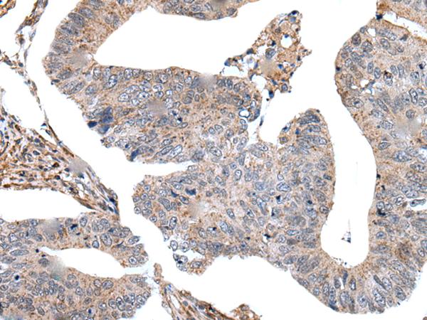 USP37 Antibody - Immunohistochemistry of paraffin-embedded Human colorectal cancer tissue  using USP37 Polyclonal Antibody at dilution of 1:45(×200)