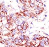 USP4 Antibody - Formalin-fixed and paraffin-embedded human cancer tissue reacted with the primary antibody, which was peroxidase-conjugated to the secondary antibody, followed by AEC staining. This data demonstrates the use of this antibody for immunohistochemistry; clinical relevance has not been evaluated. BC = breast carcinoma; HC = hepatocarcinoma.