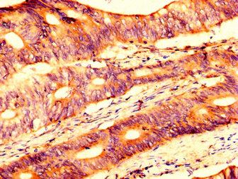 USP4 Antibody - Immunohistochemistry image at a dilution of 1:500 and staining in paraffin-embedded human colon cancer performed on a Leica BondTM system. After dewaxing and hydration, antigen retrieval was mediated by high pressure in a citrate buffer (pH 6.0) . Section was blocked with 10% normal goat serum 30min at RT. Then primary antibody (1% BSA) was incubated at 4 °C overnight. The primary is detected by a biotinylated secondary antibody and visualized using an HRP conjugated SP system.
