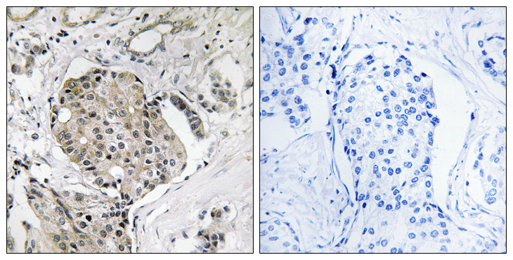 USP40 Antibody - Immunohistochemistry analysis of paraffin-embedded human breast carcinoma, using USP40 Antibody. The picture on the right is blocked with the synthesized peptide.