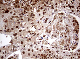 USP44 Antibody - IHC of paraffin-embedded Carcinoma of Human lung tissue using anti-USP44 mouse monoclonal antibody. (Heat-induced epitope retrieval by 10mM citric buffer, pH6.0, 120°C for 3min).