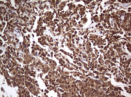 USP44 Antibody - IHC of paraffin-embedded Human lymphoma tissue using anti-USP44 mouse monoclonal antibody. (Heat-induced epitope retrieval by 10mM citric buffer, pH6.0, 120°C for 3min).