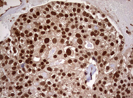USP44 Antibody - IHC of paraffin-embedded Adenocarcinoma of Human breast tissue using anti-USP44 mouse monoclonal antibody. (Heat-induced epitope retrieval by 10mM citric buffer, pH6.0, 120°C for 3min).