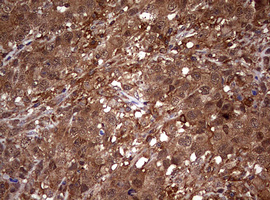 USP44 Antibody - IHC of paraffin-embedded Adenocarcinoma of Human ovary tissue using anti-USP44 mouse monoclonal antibody. (Heat-induced epitope retrieval by 10mM citric buffer, pH6.0, 120°C for 3min).