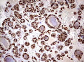 USP44 Antibody - IHC of paraffin-embedded Carcinoma of Human thyroid tissue using anti-USP44 mouse monoclonal antibody. (Heat-induced epitope retrieval by 10mM citric buffer, pH6.0, 120°C for 3min).