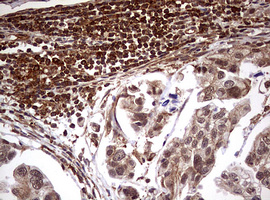 USP44 Antibody - IHC of paraffin-embedded Carcinoma of Human bladder tissue using anti-USP44 mouse monoclonal antibody. (Heat-induced epitope retrieval by 10mM citric buffer, pH6.0, 120°C for 3min).