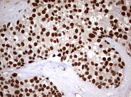 USP44 Antibody - IHC of paraffin-embedded Adenocarcinoma of Human breast tissue using anti-USP44 mouse monoclonal antibody. (Heat-induced epitope retrieval by 10mM citric buffer, pH6.0, 120°C for 3min).