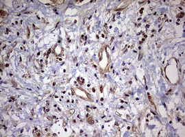 USP44 Antibody - IHC of paraffin-embedded Carcinoma of Human liver tissue using anti-USP44 mouse monoclonal antibody. (Heat-induced epitope retrieval by 10mM citric buffer, pH6.0, 120°C for 3min).