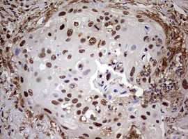 USP44 Antibody - IHC of paraffin-embedded Carcinoma of Human lung tissue using anti-USP44 mouse monoclonal antibody. (Heat-induced epitope retrieval by 10mM citric buffer, pH6.0, 120°C for 3min).