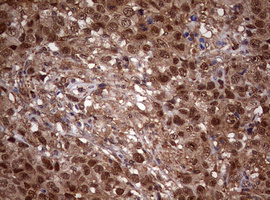 USP44 Antibody - IHC of paraffin-embedded Adenocarcinoma of Human ovary tissue using anti-USP44 mouse monoclonal antibody. (Heat-induced epitope retrieval by 10mM citric buffer, pH6.0, 120°C for 3min).