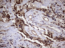 USP44 Antibody - IHC of paraffin-embedded Adenocarcinoma of Human endometrium tissue using anti-USP44 mouse monoclonal antibody. (Heat-induced epitope retrieval by 10mM citric buffer, pH6.0, 120°C for 3min).