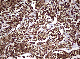USP44 Antibody - IHC of paraffin-embedded Human lymphoma tissue using anti-USP44 mouse monoclonal antibody. (Heat-induced epitope retrieval by 10mM citric buffer, pH6.0, 120°C for 3min).