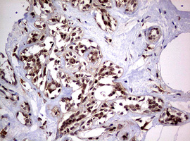 USP44 Antibody - IHC of paraffin-embedded Human breast tissue using anti-USP44 mouse monoclonal antibody. (Heat-induced epitope retrieval by 10mM citric buffer, pH6.0, 120°C for 3min).