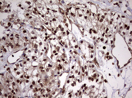 USP44 Antibody - IHC of paraffin-embedded Carcinoma of Human kidney tissue using anti-USP44 mouse monoclonal antibody. (Heat-induced epitope retrieval by 10mM citric buffer, pH6.0, 120°C for 3min).
