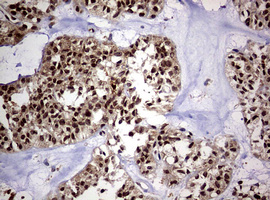 USP44 Antibody - IHC of paraffin-embedded Carcinoma of Human pancreas tissue using anti-USP44 mouse monoclonal antibody. (Heat-induced epitope retrieval by 10mM citric buffer, pH6.0, 120°C for 3min).