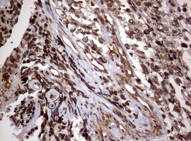 USP44 Antibody - IHC of paraffin-embedded Adenocarcinoma of Human endometrium tissue using anti-USP44 mouse monoclonal antibody. (Heat-induced epitope retrieval by 10mM citric buffer, pH6.0, 120°C for 3min).